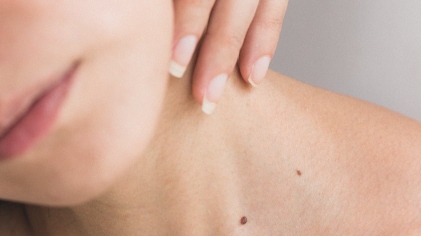 Wellnessanwendung: Micro-Needling Nahaufnahme von Frau mit Hand am Hals und sichtbaren Muttermalen